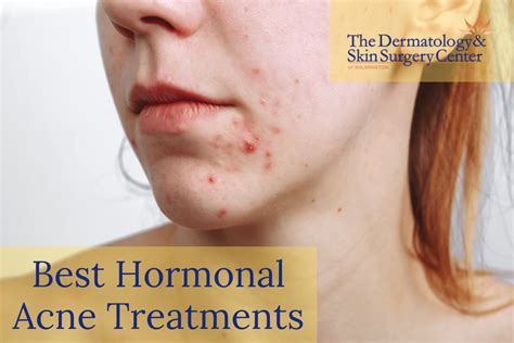 What To Know About Hormonal Acne According To A Dermatologist