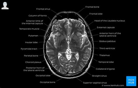 Brain Anatomy On Mri Anatomical Charts And Posters