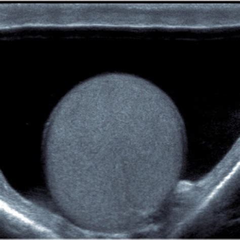 Scrotal Ultrasound Demonstrating A Non Complex Large Left Hydrocele In