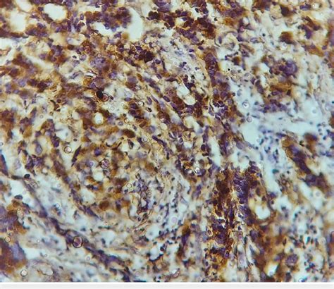 Strong Nuclear And Cytoplasmic Ihc Staining In Case Of P16 40x Ihc