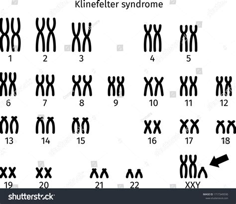 Vektor Stok Scheme Klinefelter Syndrome Karyotype Human Somatic Tanpa