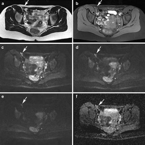 Abdominal Wall Endometriosis Awe In A 31 Year Old Woman Without A