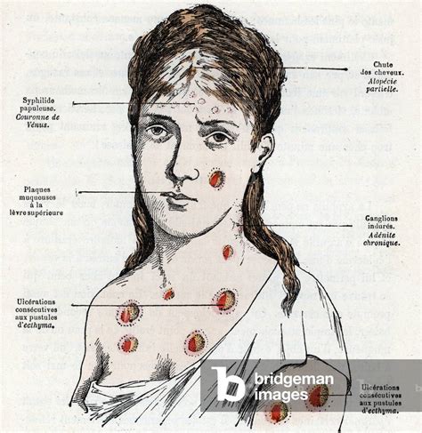 Young Woman With Syphilis Presenting With Plaques And Pustules