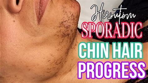 Hirsutism Sporadic Chin Hair Progress Amazing Results Youtube