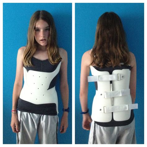 List 90 Wallpaper Before And After Scoliosis Surgery Pictures Latest