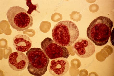 Pernicious Anaemia Light Micrograph Stock Image C0151793 Science Photo Library