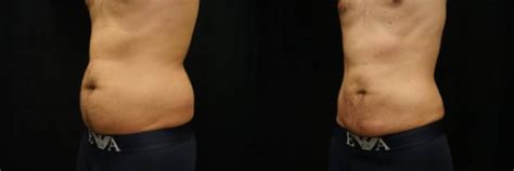 Dr Iteld Chicago Illinois 60642 29 Year Old Male Liposuction