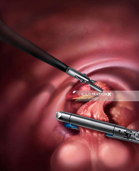 Laparoscopic Appendectomy Illustration By Alex Webber