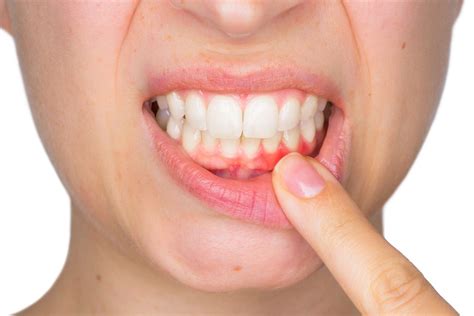 Gingivitis Vs Periodontitis The Importance Of Gum Health Beautiful