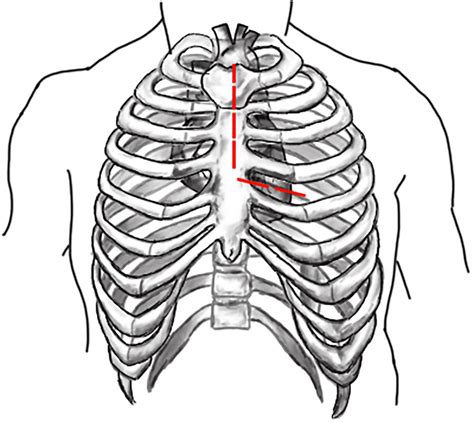 Schematic Diagram Of “l” Shaped Incision In Partial Upper Sternotomy