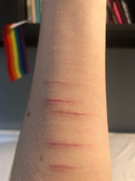 Harm Scars From A Really Stressful Week These Are The First Ones On My