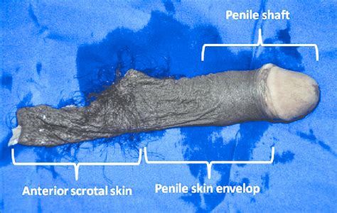 The Amputate Containing Shaft With Penile Skin Envelope