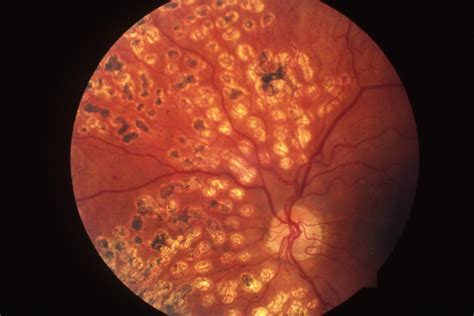 old laser burns on retina