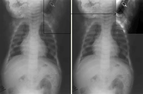 Rickets Disease X Rays