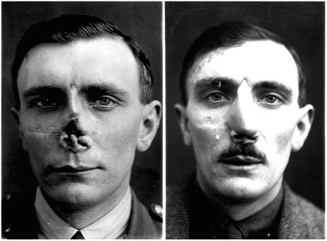 Faces From The Front Incredible Before And After Photos Show World War