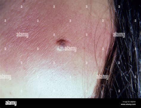 Mole Benign Nevus On Skin Non Cancerous Stock Photo Alamy
