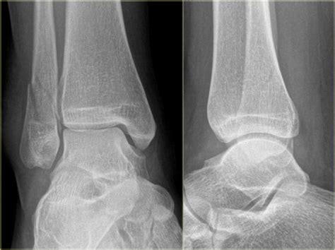 The Radiology Assistant Ankle Fractures Weber And Lauge Hansen