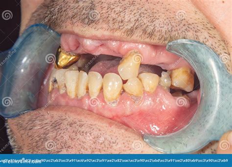 Rotten Teeth Caries And Plaque Close Up In An Asocially Ill Patient