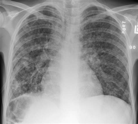 Imaging Of Chronic Granulomatous Disease In Children Radiographics