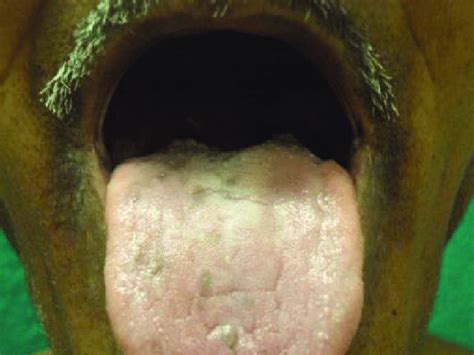 Hyperpigmented Spots On Tongue Download Scientific Diagram
