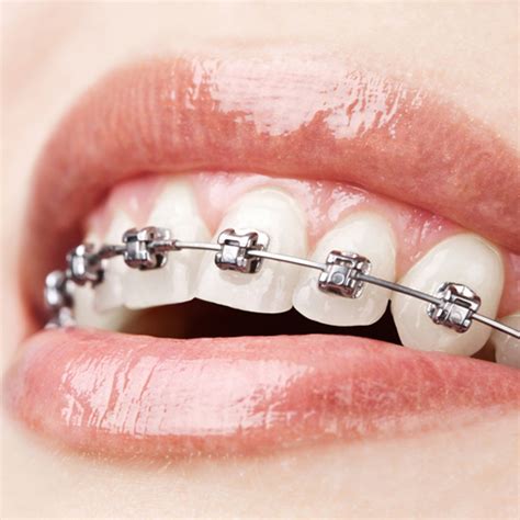 Traditional Braces Orthodontic Treatment In Lane Cove Lane Cove