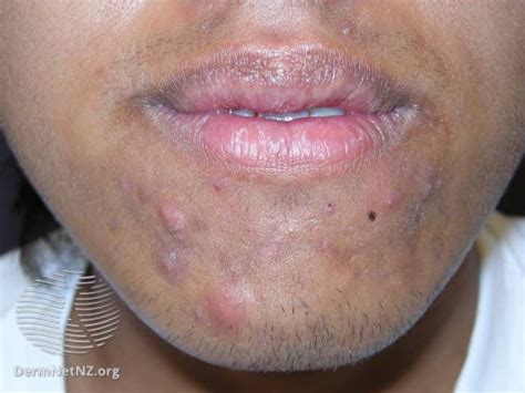 Overview Of The Types And Stages Of Acne 2023