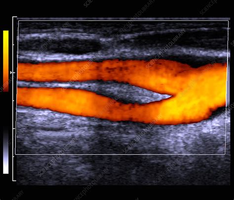 Carotid Artery Doppler Ultrasound Stock Image P Science