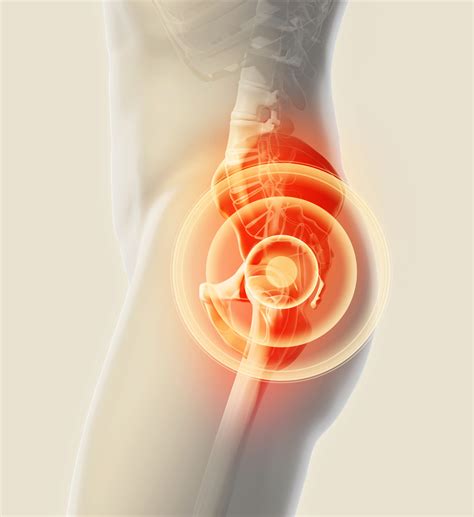 Physiotherapy For Hip Bursitis Turramurra Sports And Spinal Physiotherapy To Restore Lifestyle