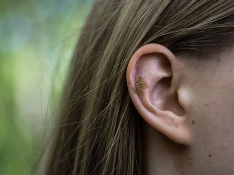 Is My Ear Eczema Infected The Signs And Symptoms Of Aural Dermatitis