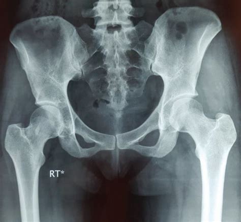 Preoperative Anteroposterior Pelvic X Ray Of A 31 Year Old Female Shows