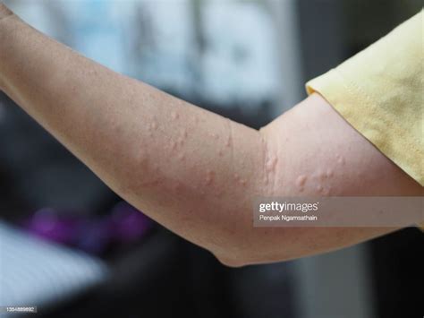 Woman Arm Swelling Red Blister Swollen Skin Rash Hit By Worm High Res