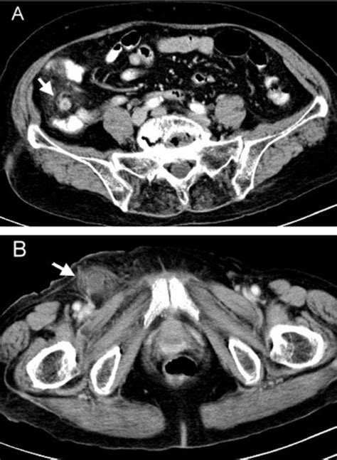 Abdomen Ct With Intravenous And Oral Constrast Demonstrating Swelling