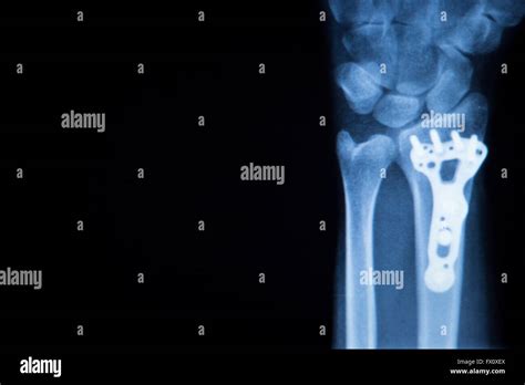 Wrist Hand Forearm And Arm Injury Medical X Ray Test Scan Result For