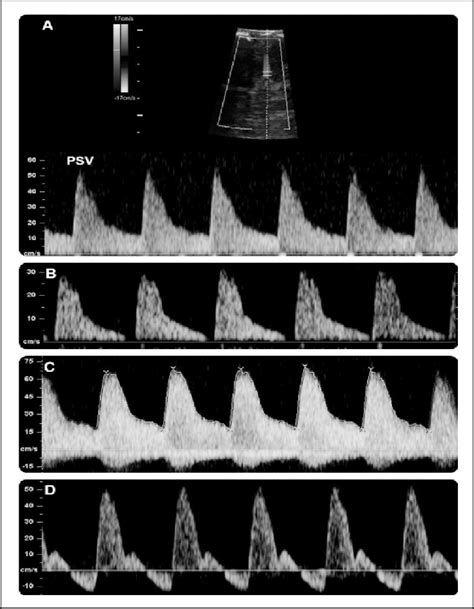 Middle Cerebral Artery MCA Waveforms 8 Demonstrating A Borderline