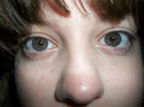 I Noticed Last Night That I Have A Freckle In My Right Iris
