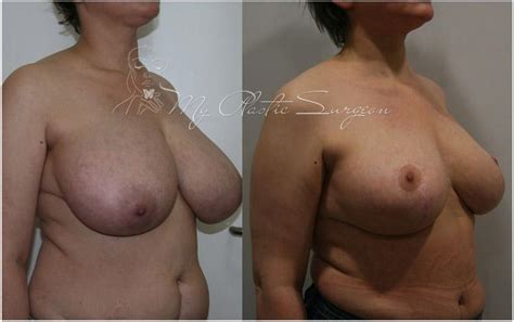 Фото до и после пластических операций Уменьшение груди от Сентября MyPlasticSurgeon ru