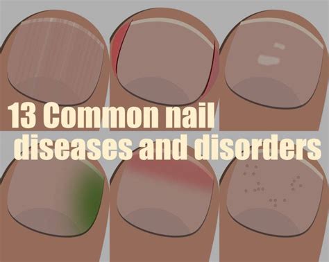 13 Common Nail Diseases And Disorders The Nail Tech Diaries