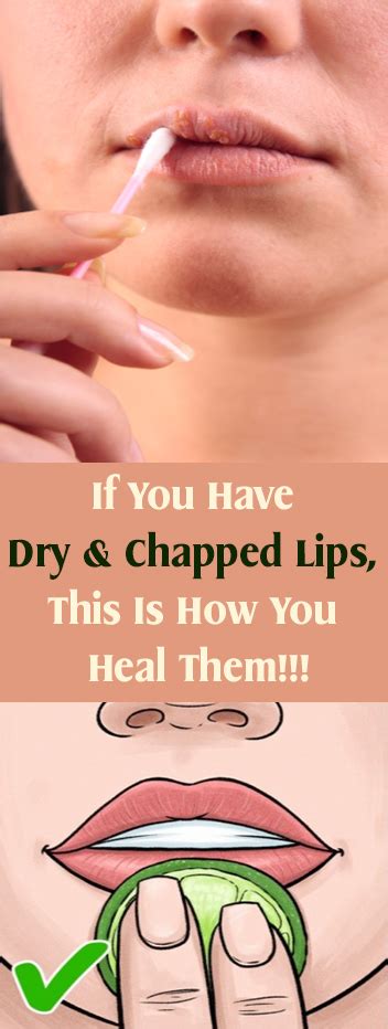 If You Have Dry And Chapped Lips This Is How You Heal Them Daily