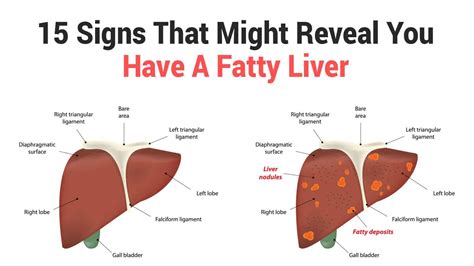 15 Signs That Might Reveal You Have A Fatty Liver 6 Minute Read