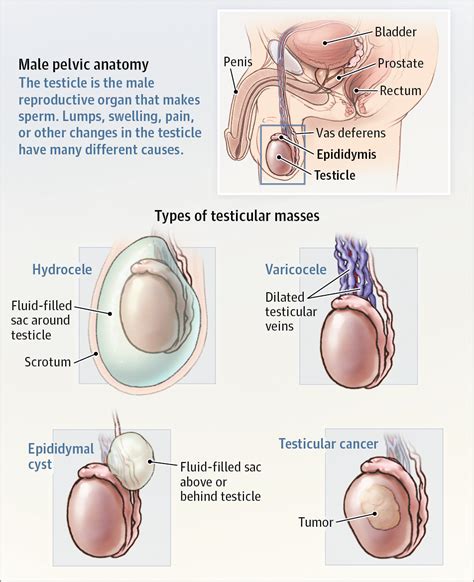 Testicular Mass Urology Jama Jama Network