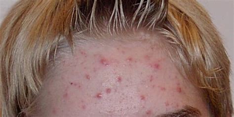 Standardized Measures Effectively Tracked Psoriasis And Acne Outcomes