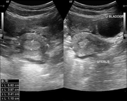 Ruptured Hemorrhagic Corpus Luteal Cyst Image Radiopaedia Org