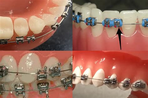 Broken Bracket On Braces The 3 Things You Need To Do