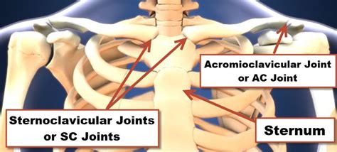 Sternoclavicular Joint Disorder