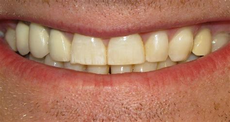 In this condition, your upper teeth protrude over your lower teeth. How to Fix an Overbite • Best In Health Care Like Natural ...