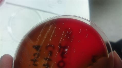 Lactobacillus The Not So Friendly Bacteria BMJ Case Reports