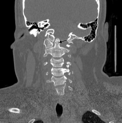 Coronal Computed Tomography Of The Cervical Spine Shows Open I