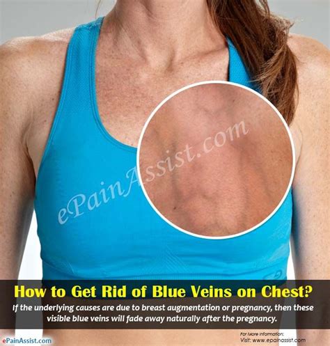 Blue Veins In Chest And Shoulders
