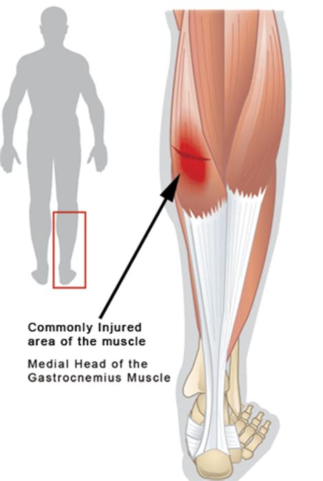 Calf Muscle Strain Chappell Physical Therapy Llc