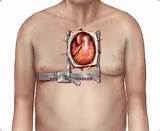 Photos of Aortic Stenosis Treatment Options